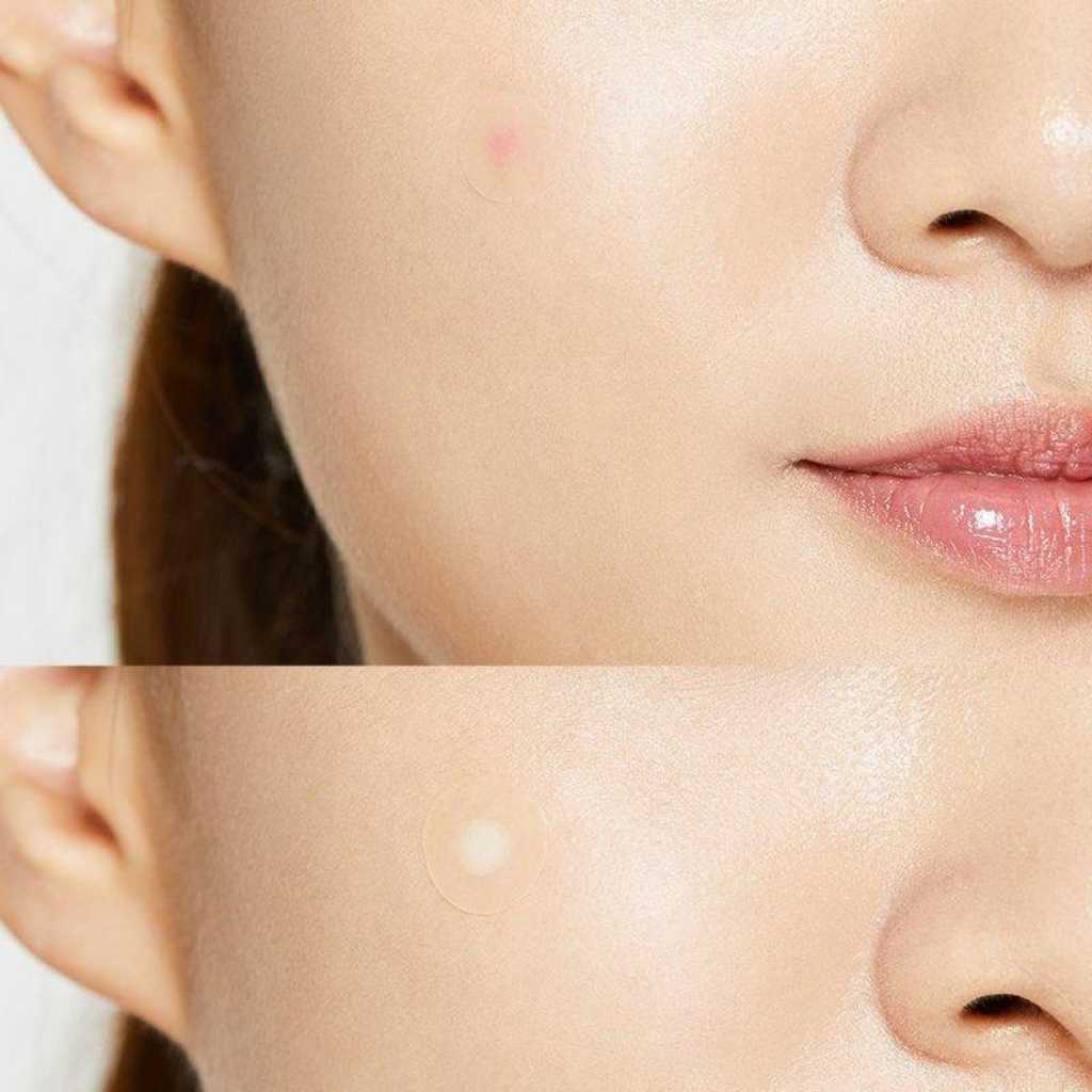 [COSRX] Pimple Master Patch